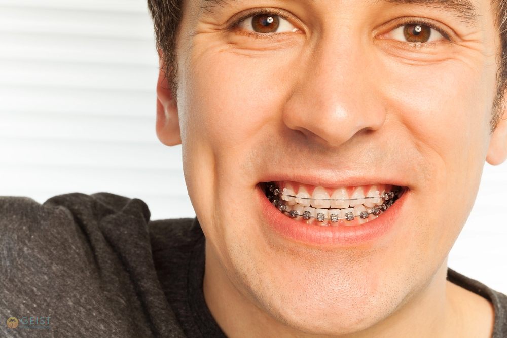 happy young man with metal braces - Overbite vs Underbite in Indianapolis, IN. 