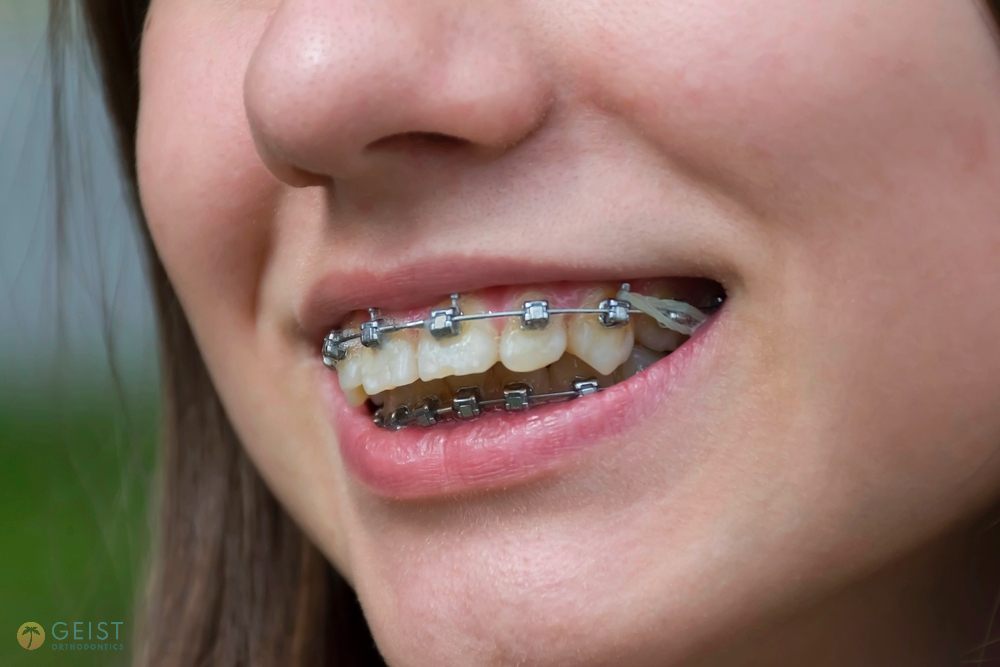 Close-up of a smiling patient showing metal braces on teeth – braces for overbite in Indianapolis, IN.